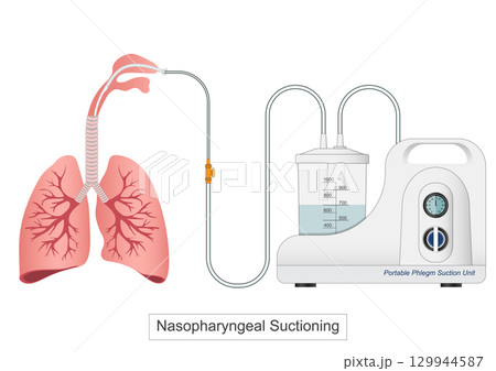 Endotracheal suctioning is a common procedure performed. Endotracheal suctioning is a common procedure performed. 129944587