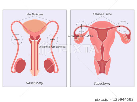 Sterilization is any of several medical methods of permanent birth control . Sterilization is any of several medical methods of permanent birth control . 129944592