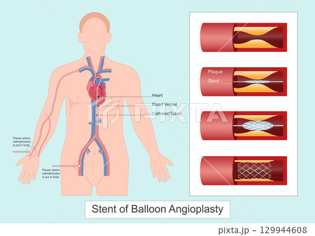 Balloon Angioplasty is a medical procedure in which a balloon 129944608