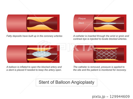 Balloon angioplasty is a minimally invasive procedure to widen narrowed or blocked arteries 129944609