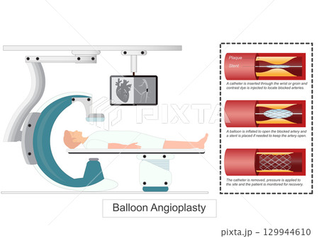 Balloon Angioplasty or Percutaneous coronary intervention (PCI) Balloon Angioplasty or Percutaneous coronary intervention (PCI) 129944610