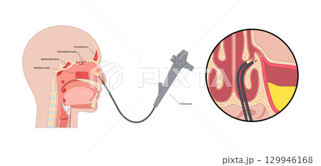 Functional Endoscopic Sinus Surgery 129946168
