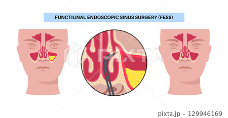 Functional Endoscopic Sinus Surgery 129946169