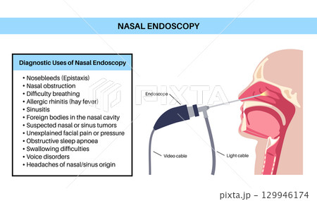 Nasal endoscopy poster 129946174