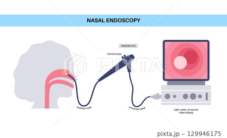 Nasal endoscopy poster Nasal endoscopy poster 129946175