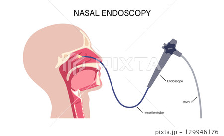 Nasal endoscopy poster 129946176