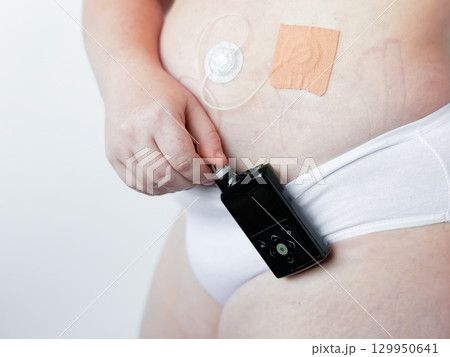 Adult caucasian female using insulin pump for diabetes management 129950641