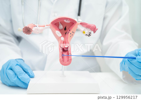 Doctor holding human uterus model for vaginal and cervix pap smear check up in the obstetrics and gynecology. 129956217