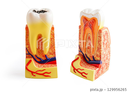 Decay tooth replace with dental implant root canal teeth model for education isolated on white background. Decay tooth replace with dental implant root canal teeth model for education isolated on white background. 129956265