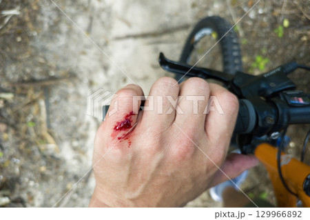 Arm injury while riding mountain bike on Florida jungle trails. Red bloody wound from hitting a tree stump. Biking accident 129966892
