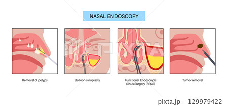 Nasal endoscopy poster 129979422