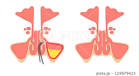 Functional Endoscopic Sinus Surgery 129979423