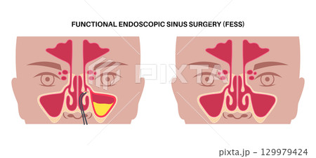 Functional Endoscopic Sinus Surgery 129979424