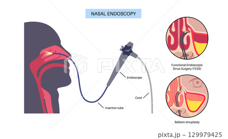 Nasal endoscopy poster 129979425