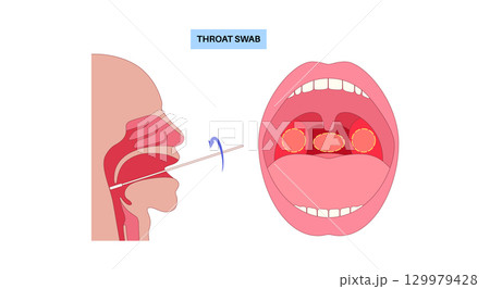 Swab throat procedure 129979428