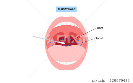 Swab throat procedure 129979432