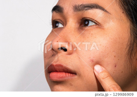 An Asian woman pointing at acne and blemishes on her cheek, showing skin problems and facial imperfections. 129986909