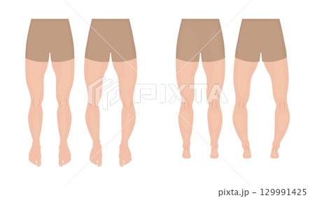 Normal legs and legs with genu varum and valgum, front and rear view Normal legs and legs with genu varum and valgum, front and rear view 129991425