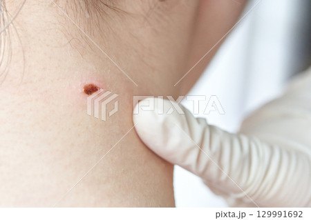 Close-up of gloved hand examining mole on caucasian adult neck for dermatology Close-up of gloved hand examining mole on caucasian adult neck for dermatology 129991692