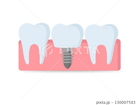 Dental implantation tooth restoration Vector illustration stock illustration Dental implantation tooth restoration Vector illustration stock illustration 130007583