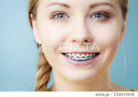 Young woman showing teeth braces Young woman showing teeth braces 130015636
