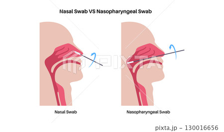 Nasopharyngeal and nasal swab Nasopharyngeal and nasal swab 130016656