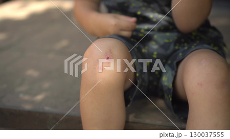 a child sits on the porch on a hot summer day he touches his scraped knee with his finger in close up wearing a t shirt and shorts a child sits on the porch on a hot summer day he touches his scraped knee with his finger in close up wearing a t shirt and shorts 130037555