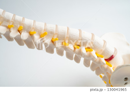 Lumbar spine displaced herniated disc fragment, spinal nerve and bone. Model for treatment medical in the orthopedic department. Lumbar spine displaced herniated disc fragment, spinal nerve and bone. Model for treatment medical in the orthopedic department. 130041965