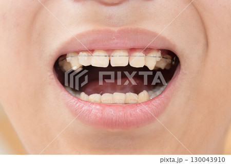 歯の矯正のイメージ 130043910