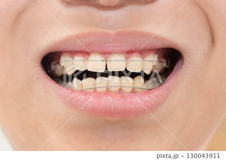 歯の矯正のイメージ 130043911