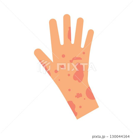 Skin rash, insect bites allergy reaction. irritation on hand logo vector illustration Skin rash, insect bites allergy reaction. irritation on hand logo vector illustration 130044164