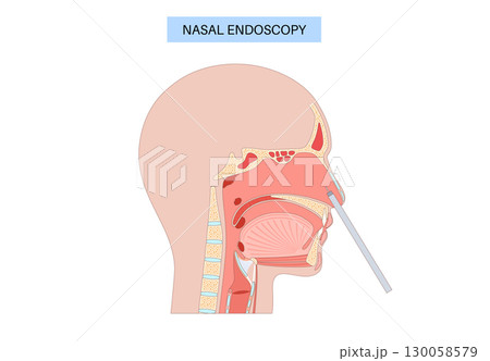 Nasal endoscopy poster 130058579