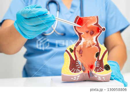 Asian doctor with rectum and hemorrhoid human anatomy model at hospital, inflamed vascular structure. Asian doctor with rectum and hemorrhoid human anatomy model at hospital, inflamed vascular structure. 130058806