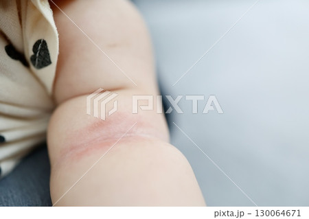 汗疹で赤くなった赤ちゃんの腕のアップと肌トラブル 130064671