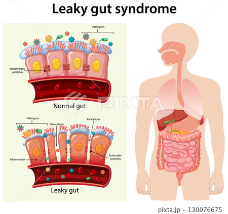 Comparison of Normal and Leaky Gut Syndrome Illustration Comparison of Normal and Leaky Gut Syndrome Illustration 130076675