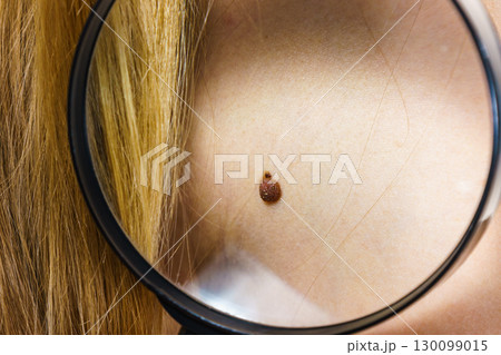 Closeup brown mole on skin. 130099015