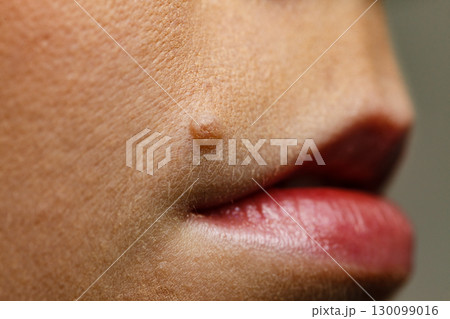 Part of woman face with mole close up Part of woman face with mole close up 130099016