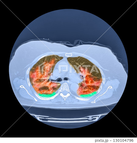 Lungs affected by Covid-19 pneumonia, CT scan 130104796