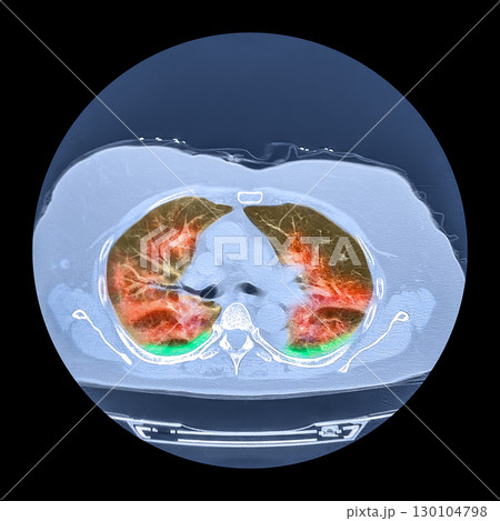 Lungs affected by Covid-19 pneumonia, CT scan Lungs affected by Covid-19 pneumonia, CT scan 130104798