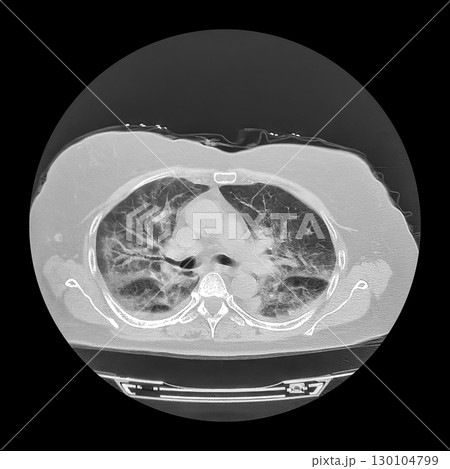 Lungs affected by Covid-19 pneumonia, CT scan 130104799