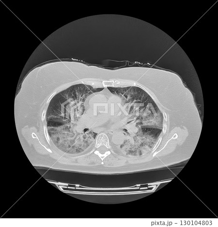 Lungs affected by Covid-19 pneumonia, CT scan Lungs affected by Covid-19 pneumonia, CT scan 130104803
