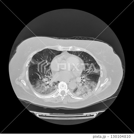 Lungs affected by Covid-19 pneumonia, CT scan Lungs affected by Covid-19 pneumonia, CT scan 130104810