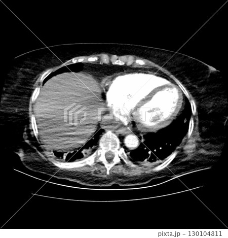 CT scan showing right ventricular strain in a patient with pulmonary embolism, highlighting right ventricular enlargement and flattening of the interventricular septum 130104811