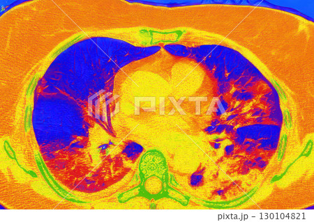 Lungs with COVID-19 pneumonia, color-enhanced CT scan showing normal lung tissue in blue and affected bilateral areas with ground-glass opacities and crazy-paving patterns in orange-red Lungs with COVID-19 pneumonia, color-enhanced CT scan showing normal lung tissue in blue and affected bilateral areas with ground-glass opacities and crazy-paving patterns in orange-red 130104821
