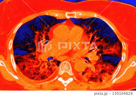 Lungs with COVID-19 pneumonia, color-enhanced CT scan showing normal lung tissue in dark blue and affected bilateral areas with ground-glass opacities and crazy-paving patterns in red 130104829