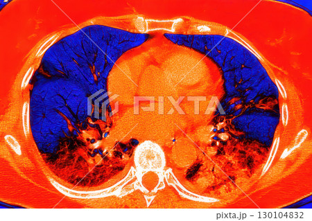 Lungs with COVID-19 pneumonia, color-enhanced CT scan showing normal lung tissue in dark blue and affected bilateral areas with ground-glass opacities and crazy-paving patterns in red Lungs with COVID-19 pneumonia, color-enhanced CT scan showing normal lung tissue in dark blue and affected bilateral areas with ground-glass opacities and crazy-paving patterns in red 130104832