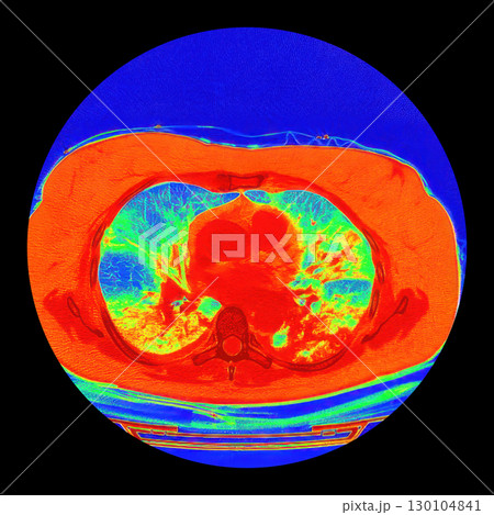 Lungs with COVID-19 pneumonia, color-enhanced CT scan showing normal lung tissue in blue-green and affected bilateral areas with ground-glass opacities and crazy-paving patterns in orange-red 130104841