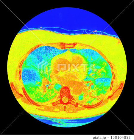 Lungs with COVID-19 pneumonia, color-enhanced CT scan showing normal lung tissue in blue and affected bilateral areas with ground-glass opacities and crazy-paving patterns in green to yellow Lungs with COVID-19 pneumonia, color-enhanced CT scan showing normal lung tissue in blue and affected bilateral areas with ground-glass opacities and crazy-paving patterns in green to yellow 130104852