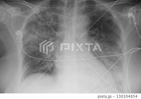 Human lungs with COVID-19 pneumonia, chest X-ray showing bilateral lung infiltrates with interstitial opacities 130104854
