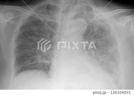 Human lungs with COVID-19 pneumonia, chest X-ray showing bilateral lung infiltrates with interstitial opacities 130104855